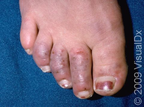 Typical to Raynaud's disease, this image displays purple toes due to constricted blood vessels.