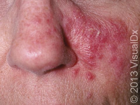 This image displays a bump-like form (one of many) of rosacea.