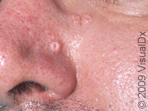 This image displays collections of sebaceous glands on the skin that appear as whitish-to-yellow skin bumps.