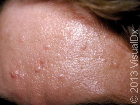 Sebaceous hyperplasia features skin-colored to yellow-white elevations of the skin that are often seen on the forehead.