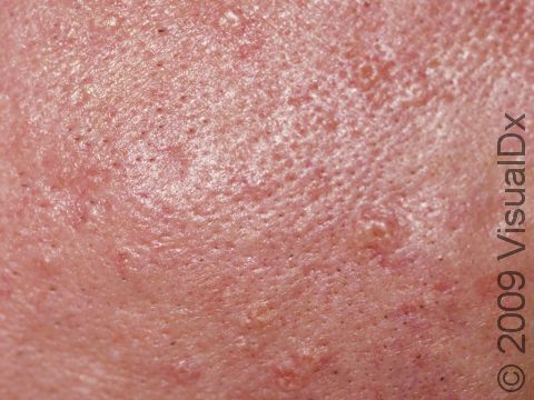 The small, smooth elevations of the skin have a faint yellow-white color and can be very subtle in sebaceous hyperplasia.