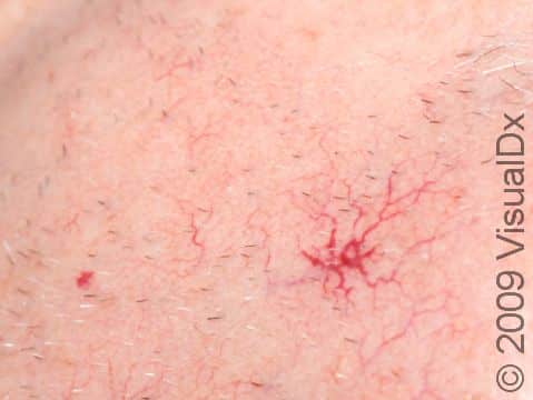 This spider angioma is seen on a background of sun damage on the cheek, with multiple small linear veins nearby.