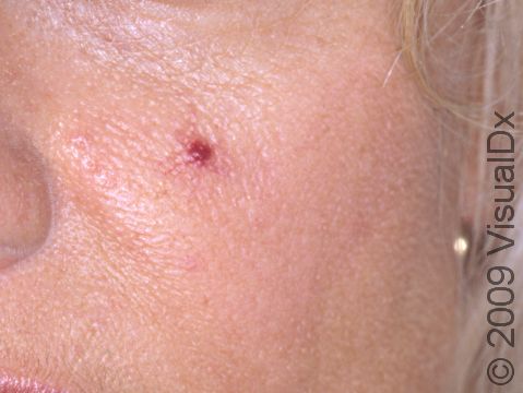As displayed in this image, an angioma can sometimes just look like a red bump, with subtle, tiny radiating blood vessels around it.