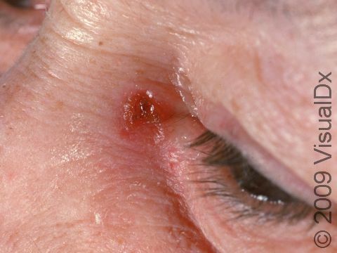 Squamous cell carcinoma frequently appears on the face, as displayed in this image.