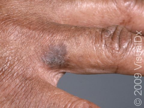 This image displays a squamous cell carcinoma on a black patient, which is infrequent.