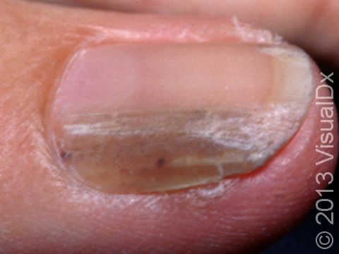 This squamous cell carcinoma under the toenail has a pink to brown streak of discoloration of the nail plate as well as a thickened, rough area at the edge and under the nail plate.