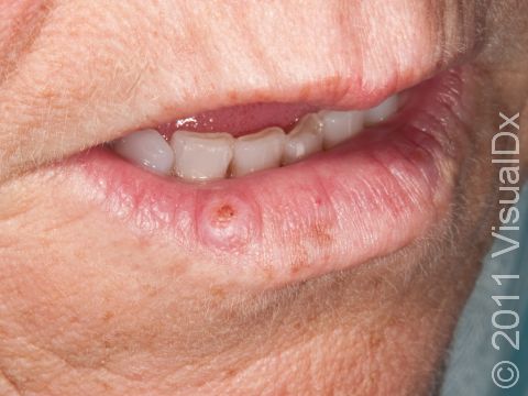 Squamous cell cancer of the lips can present as a nonpainful, enlarging over time, chronic sore or bump.  