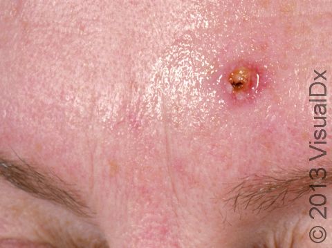 As displayed in this early squamous cell carcinoma, a small, elevated lesion may be accompanied with scale or a crust.