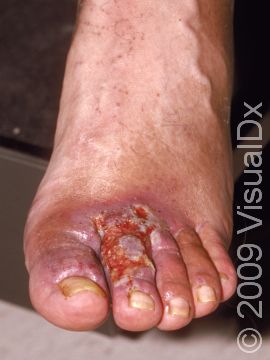 This image displays severe stasis ulcers that result from chronic leg swelling.