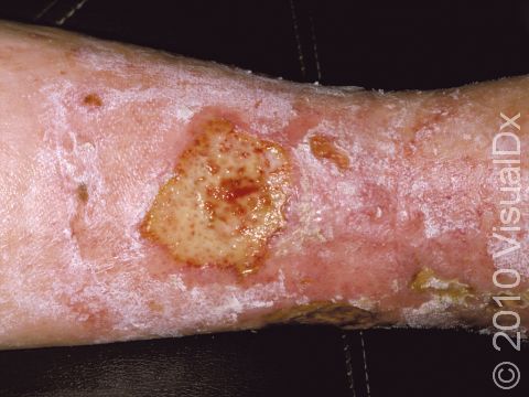 This image displays a large, superficial ulcer within a red, elevated lesion typical of stasis dermatitis.
