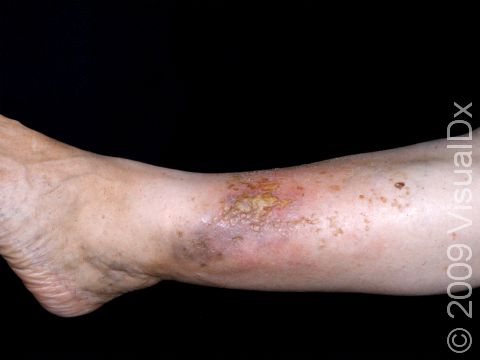 This image displays a patient with chronic leg swelling with stasis dermatitis and a stasis ulcer.