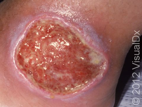 This image displays a large area of skin inflammation and skin breakdown on the ankle typical to stasis ulcers.
