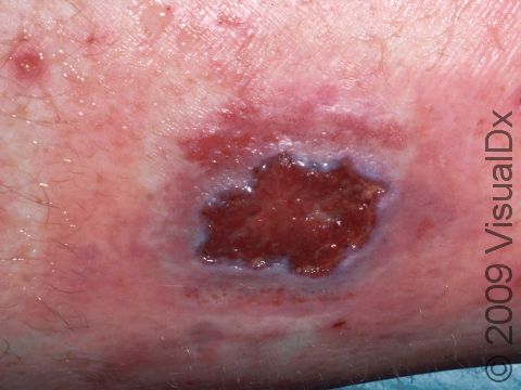 Chronic leg swelling from poor leg vein circulation can lead to skin inflammation and an eventual skin ulcer.