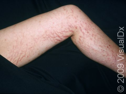 This image displays extensive striae (stretch marks) on the leg.