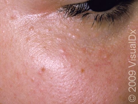 Syringomas are benign, skin-colored elevations of the skin typically found around the eyes, including on the eyelids.