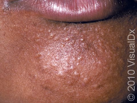 Typical to syringomas, this image displays multiple skin-colored, firm, small lesions. These benign lesions typically appear near the eyelids, but they can occur lower on the face or even the trunk of the body.