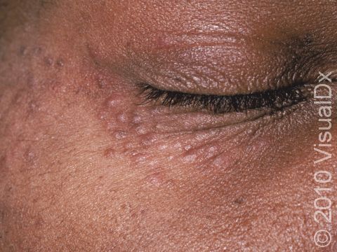 This image displays the classic elevations of the skin typical of syringomas.