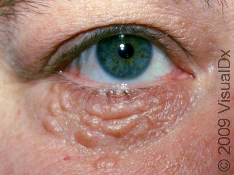 This image displays the cobblestone appearance of the skin under the eyes typical of multiple syringomas.