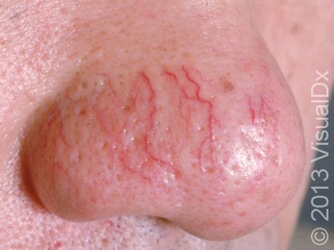 This image displays telangiectasias on the nose.