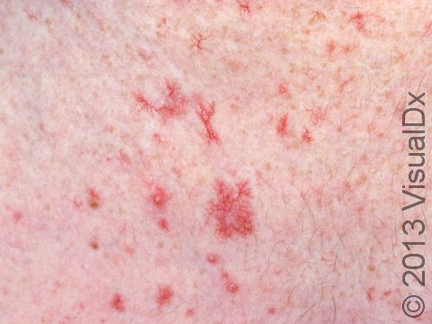 This image displays an area of sun damaged skin with multiple telangiectasias.