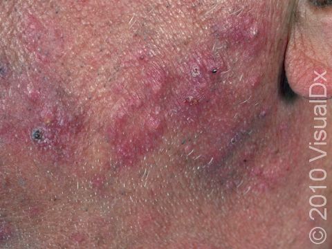 This patient has fungal infection of the hair follicles, leading to multiple red bumps and crusts rather than a circle shape of typical ringworm on the skin surface.