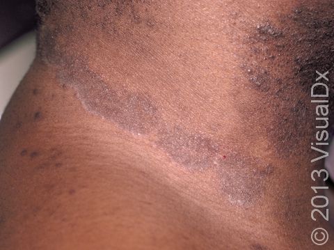 In dark-skinned patients, the lesions of tinea corporis can be deeply pigmented.