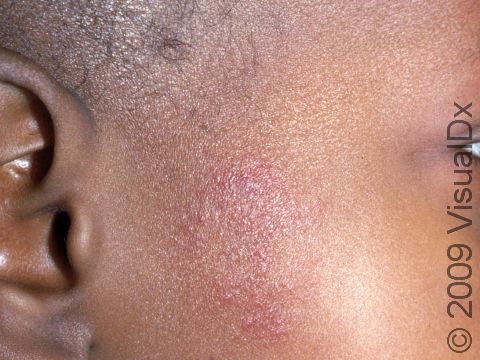 Early forms of fungal infections, such as this image displaying tinea faciale, can appear as a mild area of skin redness and scaling.