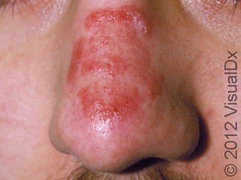 A red (erythematous) slightly elevated lesion with scaling along the edge is typical of tinea faciale.