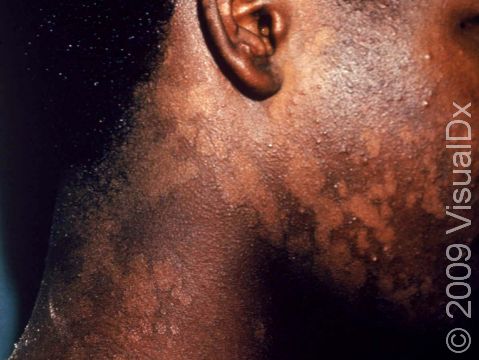 Tinea versicolor typically causes areas of skin lightening or darkening with very sharp borders between the color changes, as displayed in this image.