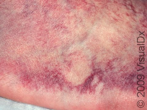 This image displays the purple discoloration typical of varicosities.