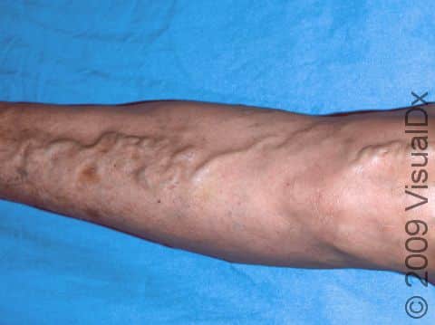 This image displays dilated varicose veins typical of varicosities.