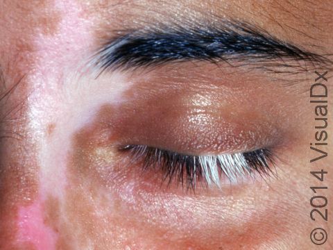 The loss of pigment from hairs in the eyelash area accentuates the color loss of vitiligo.