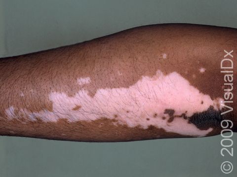 The pigment loss in this woman with vitiligo forms an irregular patch.