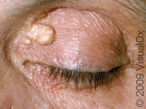 Xanthelasma are most often white-yellow or yellow-orange bumps found on the eyelids.