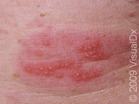 Grouped, depressed blisters on a red base are typical of zoster (shingles).