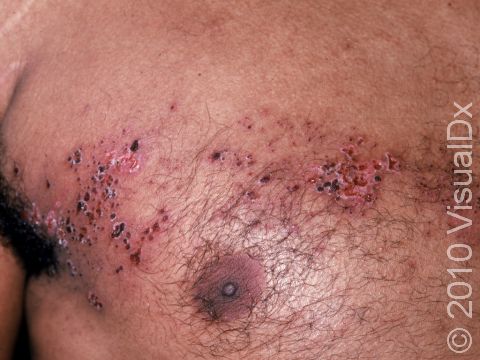 This image displays zoster (shingles) with blisters that are crusting and starting to heal.