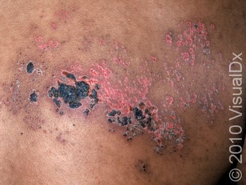 This image displays healing zoster (shingles) with the bloody crusts from the blisters beginning to fall off, leaving small skin erosions.