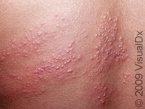 This image displays clear, fluid-filled blisters on a background of inflamed skin typical of early zoster (shingles).