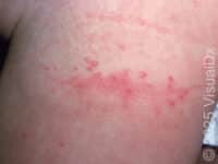 Diaper Rash (Irritant Diaper Dermatitis) – Infant