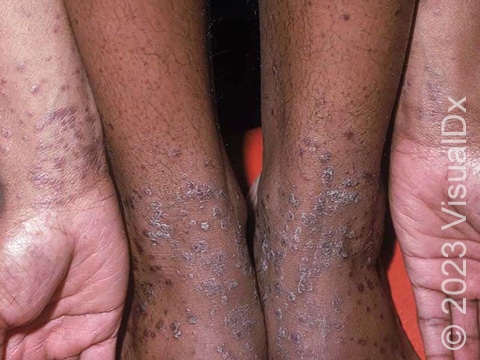 Scattered, scaly, purple-colored skin lesions of the extremities, consistent with lichen planus.