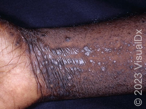 Lichen planus of the wrist and forearm showing raised skin lesions with a smooth silverly scale.