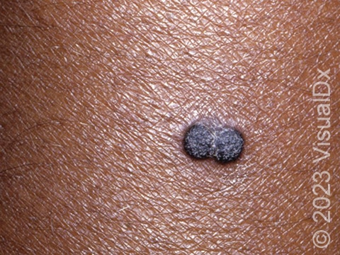 Widespread seborrheic keratoses of the trunk in an individual with darkly pigmented skin.