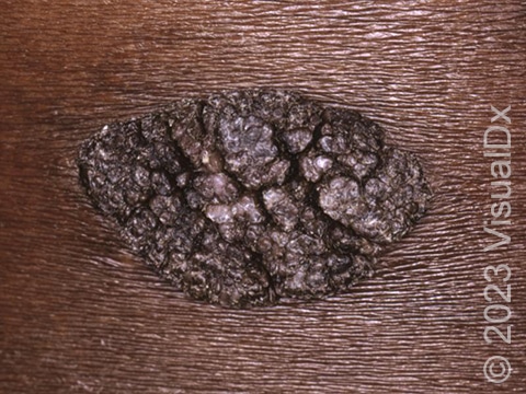The thickened irregular surface of a seborrheic keratosis of the skin.