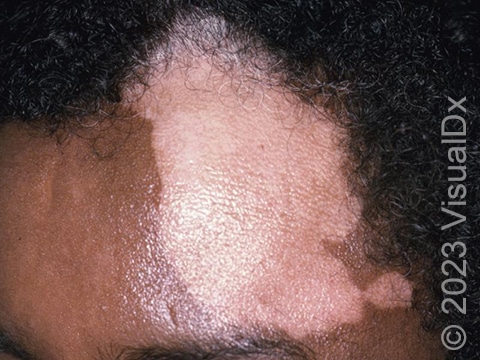 Depigmented white skin on the forehead of a patient with vitiligo.