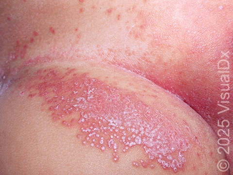 Candida Albicans Diaper Rash Candida Albicans Diaper Rash