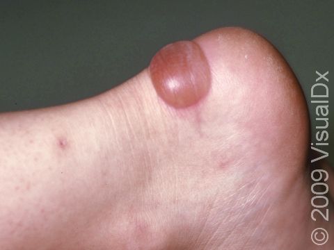 Blisters on the feet are a common result of wearing ill-fitting shoes.