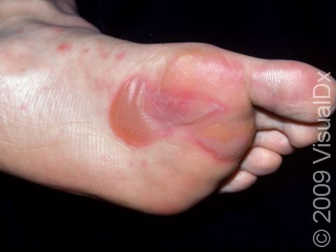 This severe blister is in a common location for athletes: the bottom of the foot.