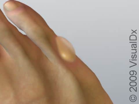 This large single blister appears as if it could pop on its own and can be safely drained by following the proper procedures discussed in the First Aid Guide.