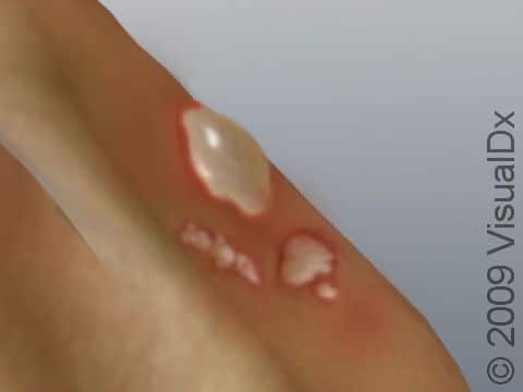 The grouped blisters in this image exemplify the type of multiple, grouped blisters that you should not attempt to drain. Further, this type of blister configuration should warrant a visit to the doctor.