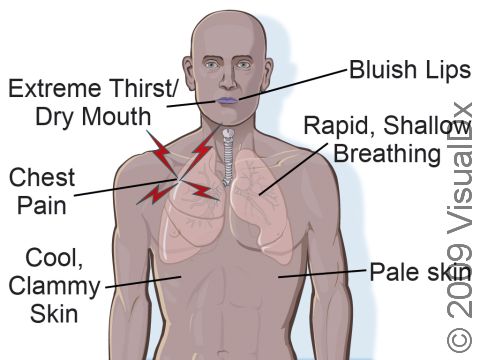 Shock signs and symptoms can include cool, clammy skin; extreme thirst / dry mouth; pale skin; bluish lips; fatigue; weakness / dizziness; vomiting; nausea; anxiety / restlessness; decreased alertness; rapid, shallow breathing; and/or rapid, weak pulse.